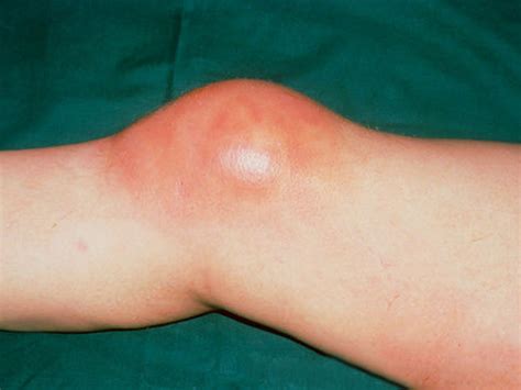 Bursitis Causes, Symptoms, Diagnosis and Treatment - Natural Health News