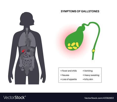 Gallbladder stones symptoms Royalty Free Vector Image