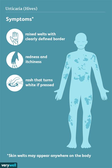 Urticaria (Hives): Signs, Symptoms, and Complications