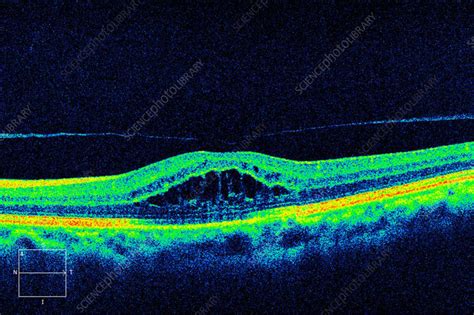 Cystoid macular oedema, OCT scan - Stock Image - C057/0658 - Science ...