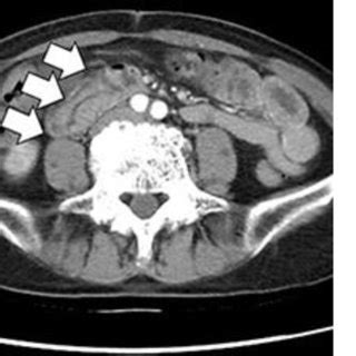 Contrast-enhanced computed tomography. The two images show the height... | Download Scientific ...