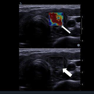 Patient 1. Heterogeneous, decreased echogenicity of the left thyroid ...