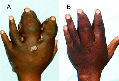 Showing hand eumycetoma (A) before surgery (B) after surgery.... | Download Scientific Diagram