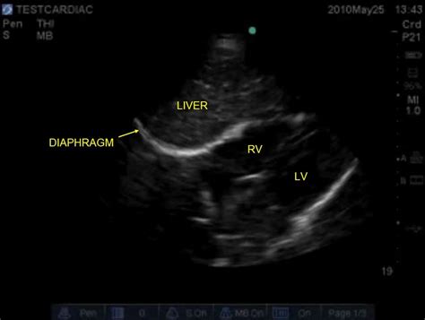 4 Basic Cardiac Echo How To - Pre-reading for FCUS Course - Intensive Care Network