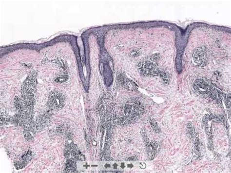 Discoid Lupus Erythematosus Histology