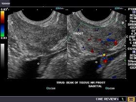 cochinblogs: Urinary bladder polyp: