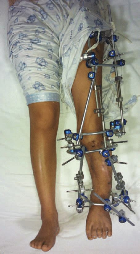 leg shortening surgery recovery timer