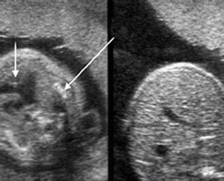 Pulmonary Hypoplasia – Department of Obstetrics and Gynecology Faculty of Medicine Chiang Mai ...