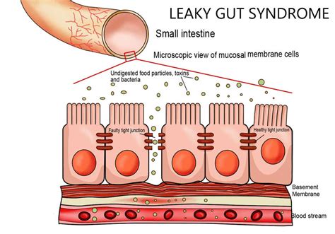 Leaky Gut Demystified - True Carnivores