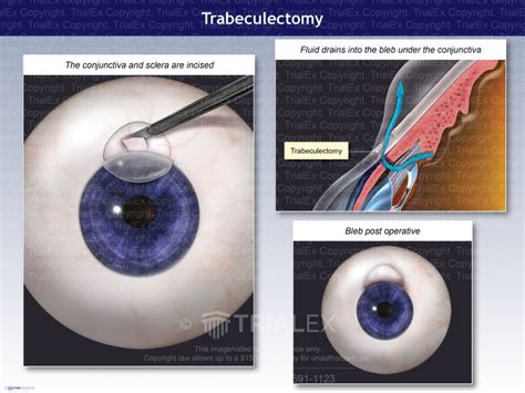 Trabeculectomy - Trial Exhibits Inc.