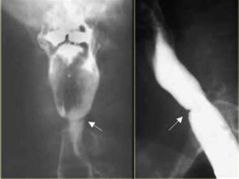 Barium swallow diseases | PPT