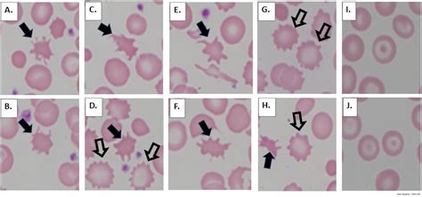 A thorny matter: Spur cell anemia | Annals of Hepatology