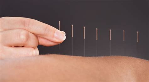 Dry Needling Near Me | Physiotherapy | Core Physio & Pilates Studio