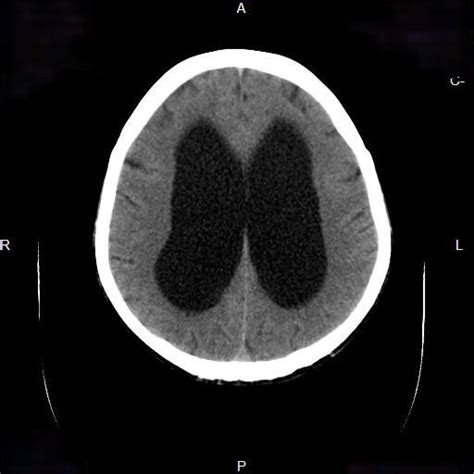 Diagnostics: The Shunt Series — Taming the SRU