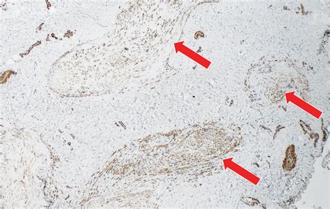 Immunohistochemical expression of alpha-smooth muscle actin (SMA) shows ...