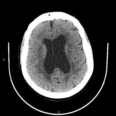 Cerebral small vessel disease | Radiology Reference Article | Radiopaedia.org