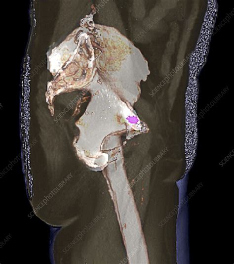 Metastatic prostate cancer, 3D CT scan - Stock Image - C023/9721 ...