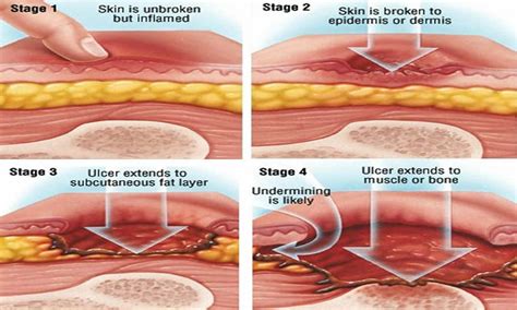 Bed sores, pressure ulcer causes, stages, prevention & pressure ulcer treatment