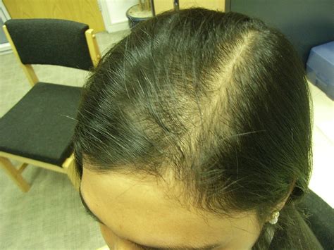 The Hair Centre | Female Hair Loss (Asian) Stabilisation And Early ...