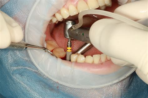 How Long Does A Dental Implant Procedure Take