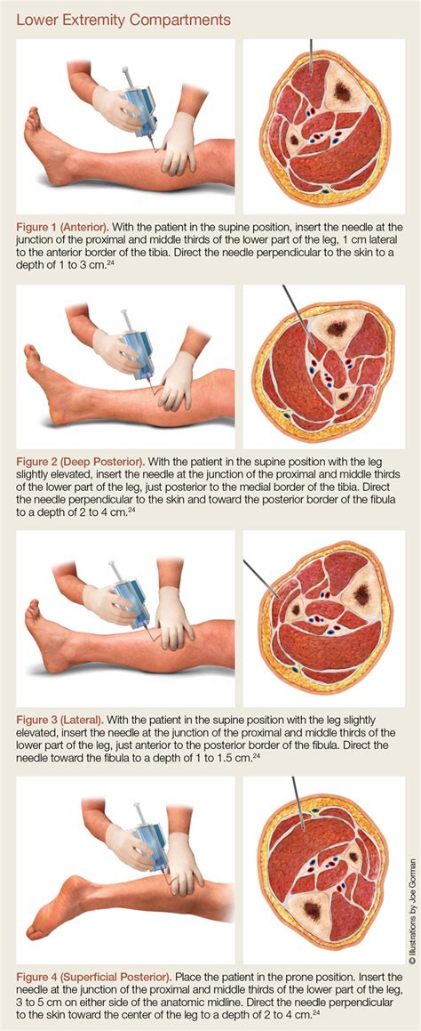 Acute Compartment Syndrome | MDedge Emergency Medicine