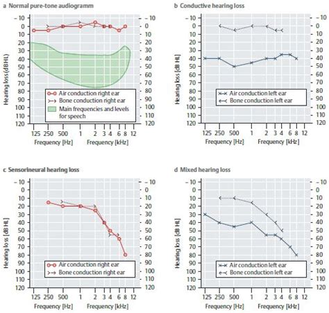 Pure Tone Audiogram and Interpretation | Epomedicine