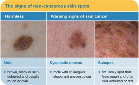 Skin cancer: the warning signs - MyDr.com.au