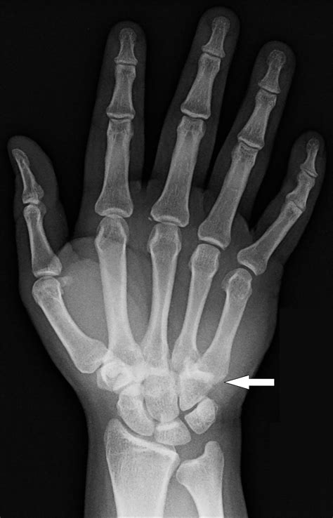 Multiple Carpometacarpal Dislocations - The Western Journal of Emergency Medicine