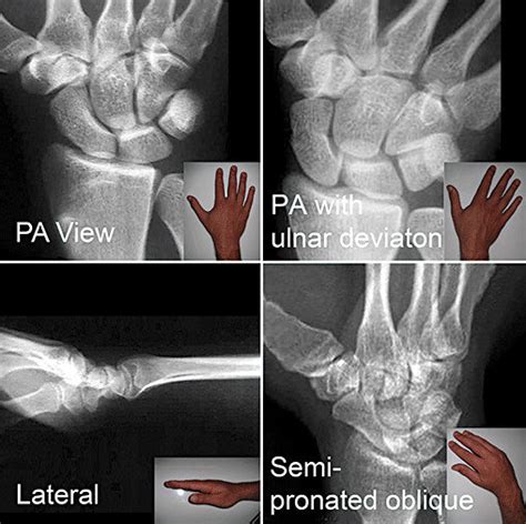 Standard recommended scaphoid x-ray views. Postero-anterior (PA), PA ...