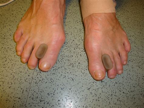 Foot and Ankle Problems By Dr. Richard Blake: Bunion Pain: Or Is It?