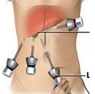 Gallbladder Stones – Laparoscopic, thoracoscopic and hernia surgery