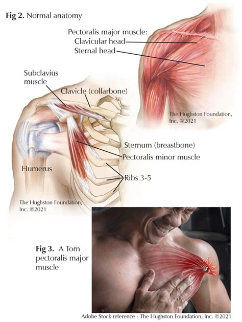 Pectoralis Major Muscle Injuries - Hughston Clinic