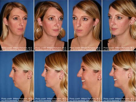 Flat Nose Before and After Photo Gallery - Nose Surgery Photos