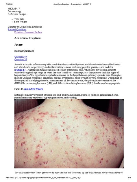 Acneiform Eruptions - Dermatology - MKSAP 17 | Acne Vulgaris | Health Sciences