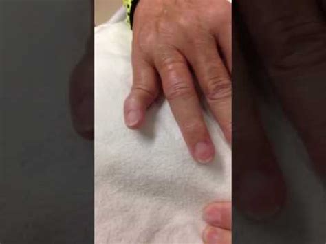 Dislocated pinky finger - YouTube