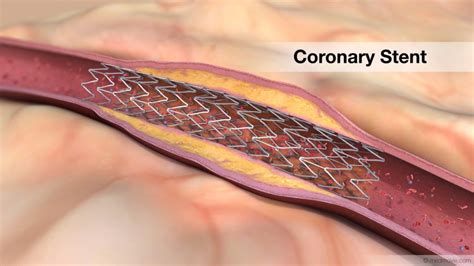 Iliac Artery Stent