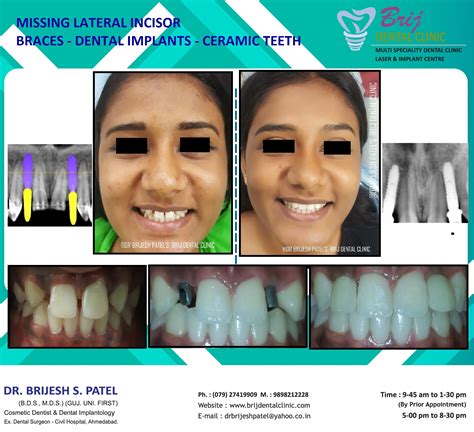 IMPLANT FOR MISSING LATERAL INCISOR- BRACES - IMPLANT- CERAMIC TEETH ...