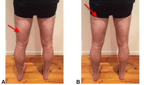 Hamstring Injury - Causes, Symptoms, Recovery Time & Treatment