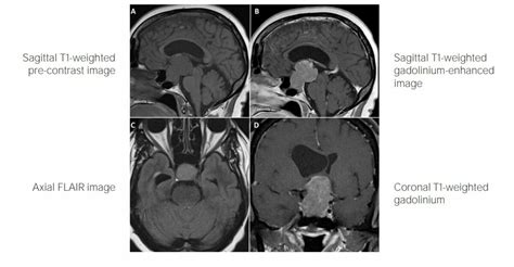 Craniopharyngioma | Concise Medical Knowledge