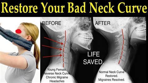 Reversal Of Cervical Lordosis Treatment - Quotes Update Viral