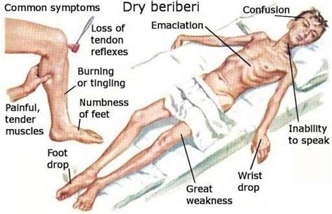 Thiamine Deficiency - Rehab Guide