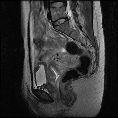 Pelvic Anatomy Mri - Human Anatomy