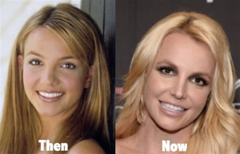 Britney Spears Before and After Plastic Surgery Reveals Her Popstar Journey