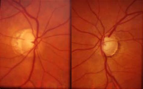 Optic nerve photographs of Subject 2 demonstrate glaucomatous optic... | Download Scientific Diagram