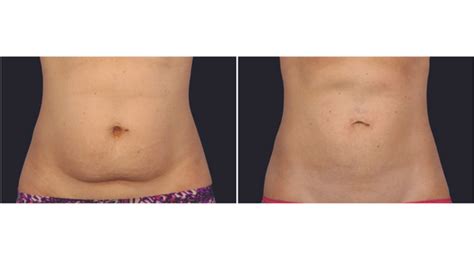 Non Surgical Fat Removal From Stomach | Vujevich Dermatology