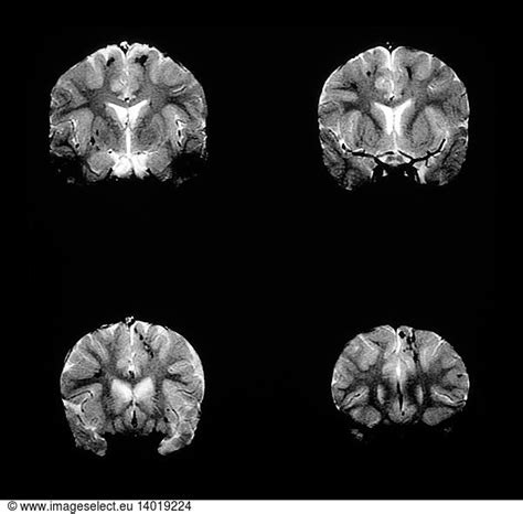 MRI of Head Trauma MRI of Head Trauma,abnormal,brain,axonal injury ...