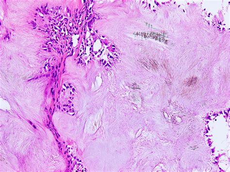 Tophus Histology