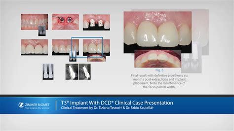 Zimmer Biomet T3® Implants* - YouTube