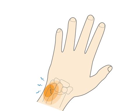 Styloid Process Of Radius Pain