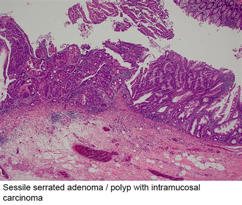 Pathology Outlines - Sessile serrated adenoma